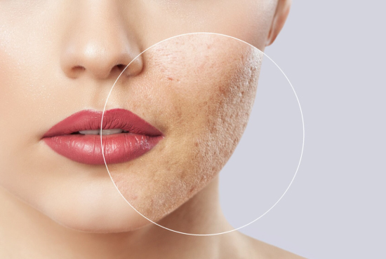 Consultation pour cicatrices d’acné à Djerba