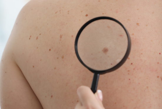 Hyperpigmentation (Taches Brunes) à Djerba