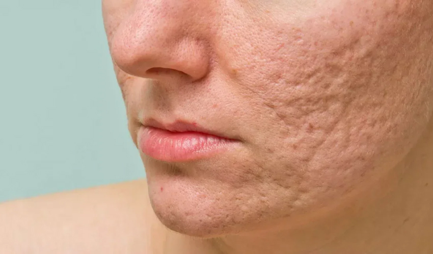 Soins efficaces pour cicatrices d’acné à Djerba